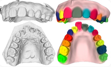 3D upper-jaw scan and multicoloured segmented dentition